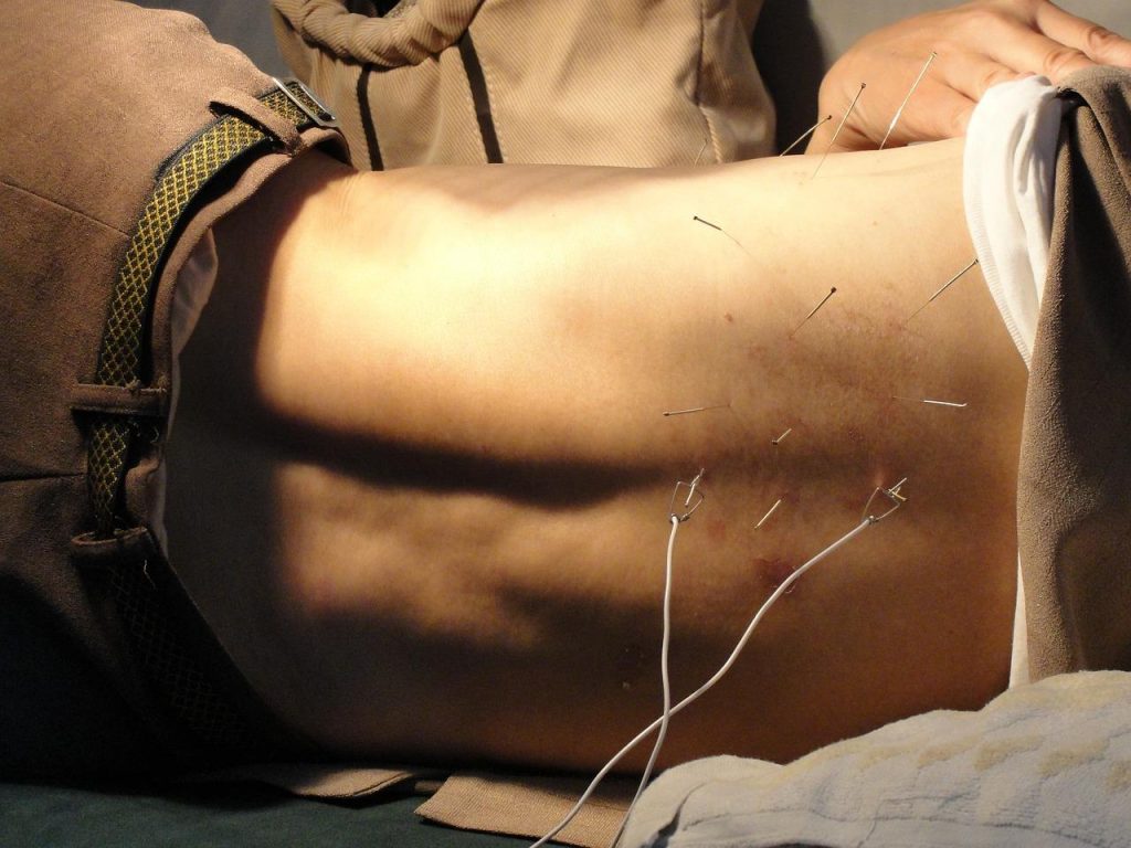 Acupuncturist in Uden behandelt patiënt met traditionele Chinese geneeskunde voor gezondheid en welzijn